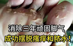 下载视频: 消除三年顽固脚臭的有效方法，成功摆脱瘙痒和脓水！