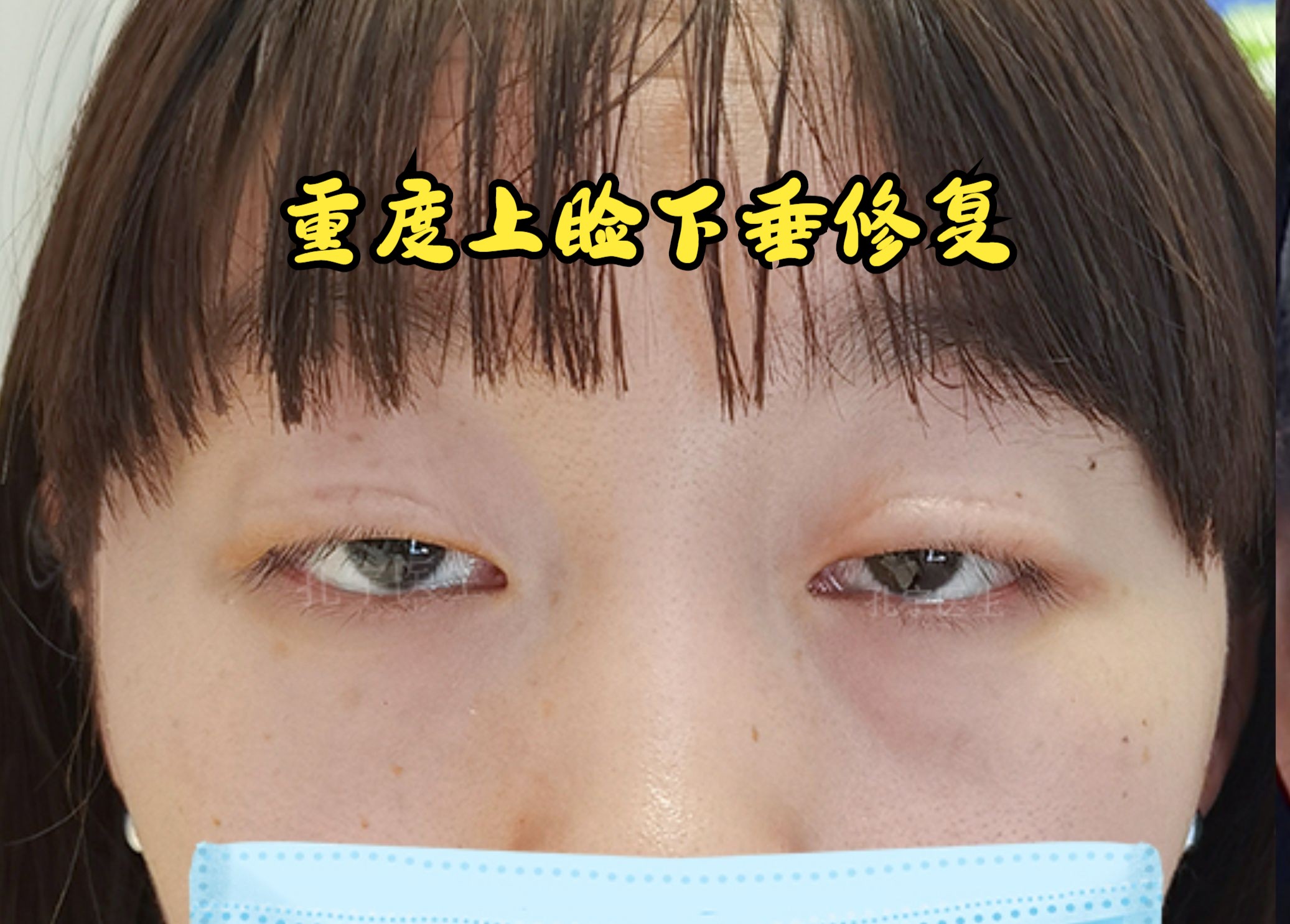 湖南姑娘重度上睑下垂复发修复后4个月双眼对称有神,姑娘满意.