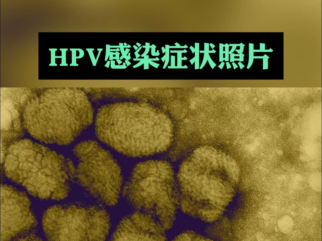 HPV感染的症状照片哔哩哔哩bilibili