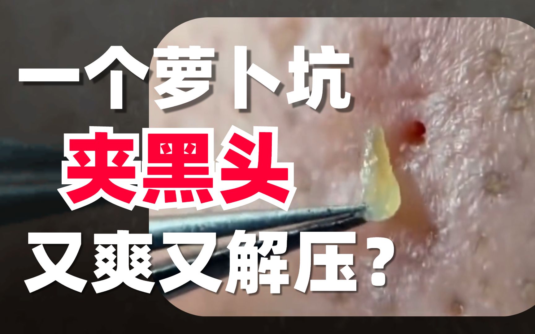 来看孙叔教你去黑头大法-屑不肉不多肉-有用的-哔哩哔哩视频