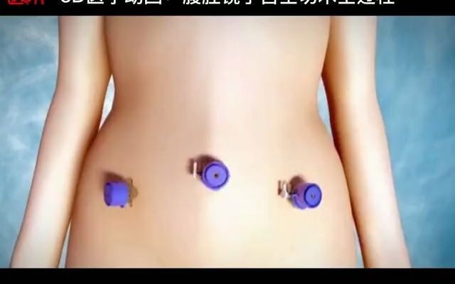 3D医学动画:腹腔镜子宫全切手术哔哩哔哩bilibili