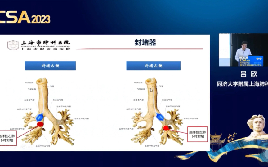 胸科手术肺隔离技术进展哔哩哔哩bilibili