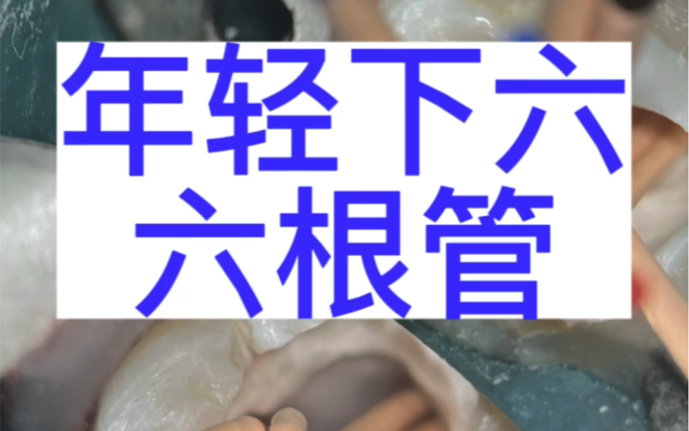 根管治疗年轻下颌第一磨牙6根管,近中远中都是三根管 #口腔医生 #年轻恒牙 #根管太多哔哩哔哩bilibili