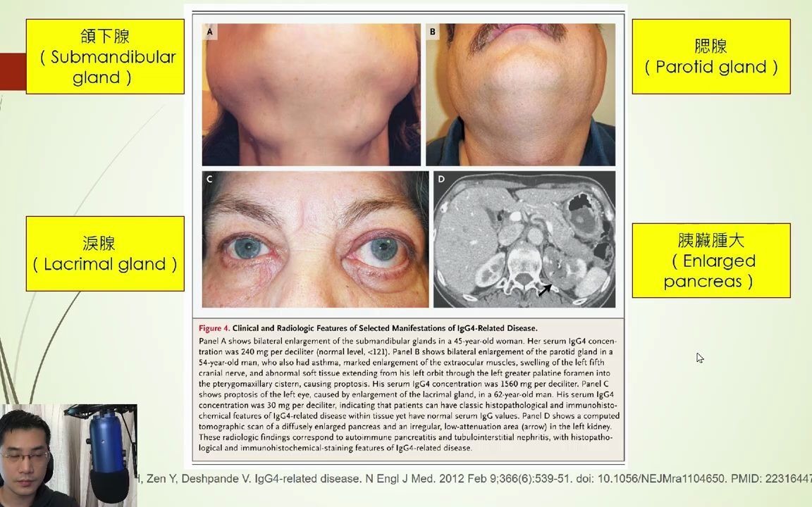 【医学科普】 igG4相关性疾病 多处浸润 Part2 风湿免疫科 双语实用内科学课程系列哔哩哔哩bilibili