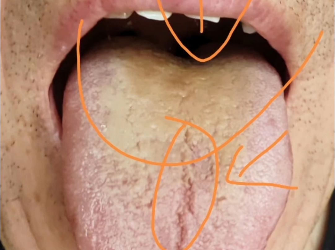 下焦湿热,中焦胃阴不足,出现尿黄,大便黏腻,蛋蛋潮湿等现象!