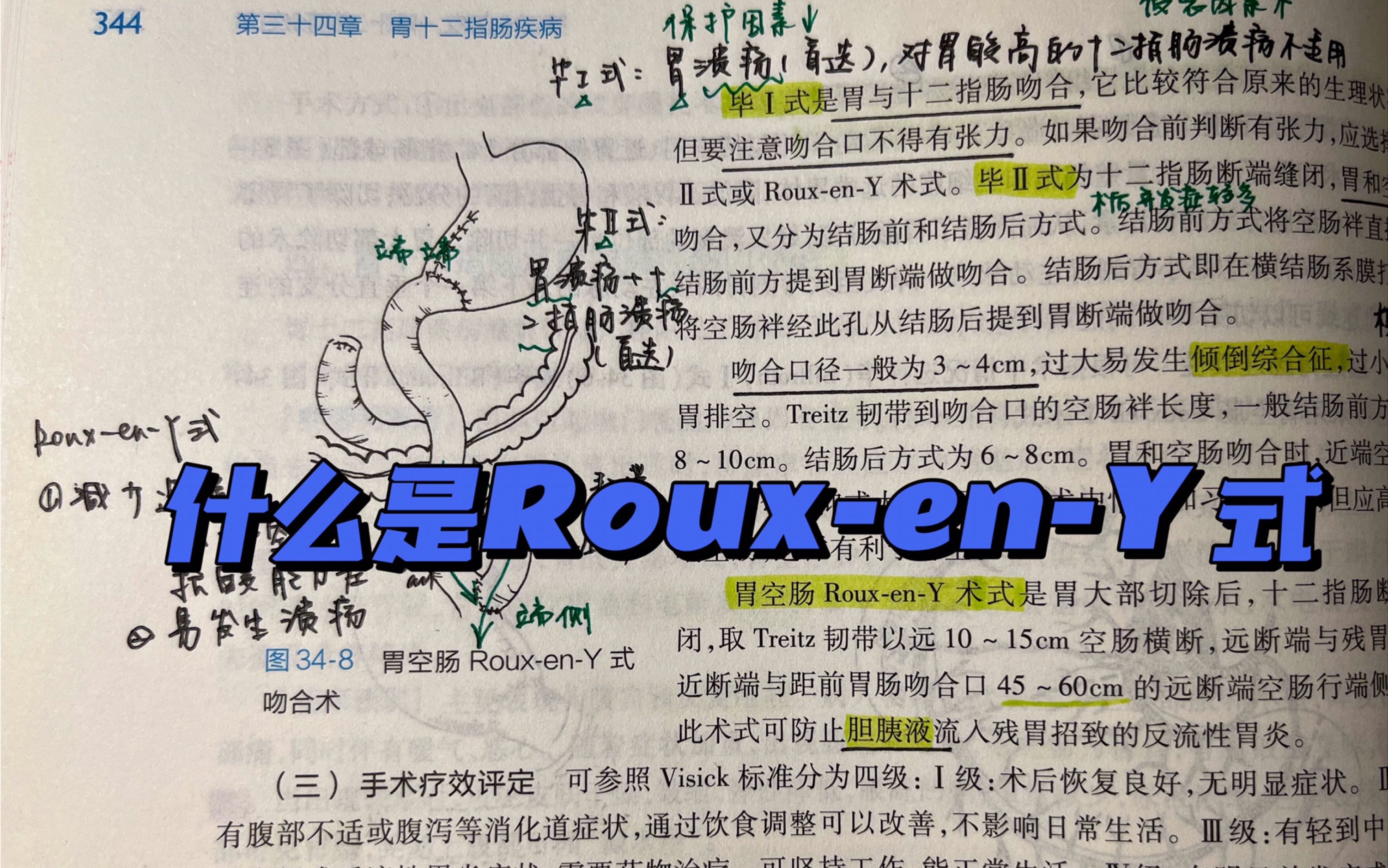 [图]胃空肠Roux-en-Y式吻合术