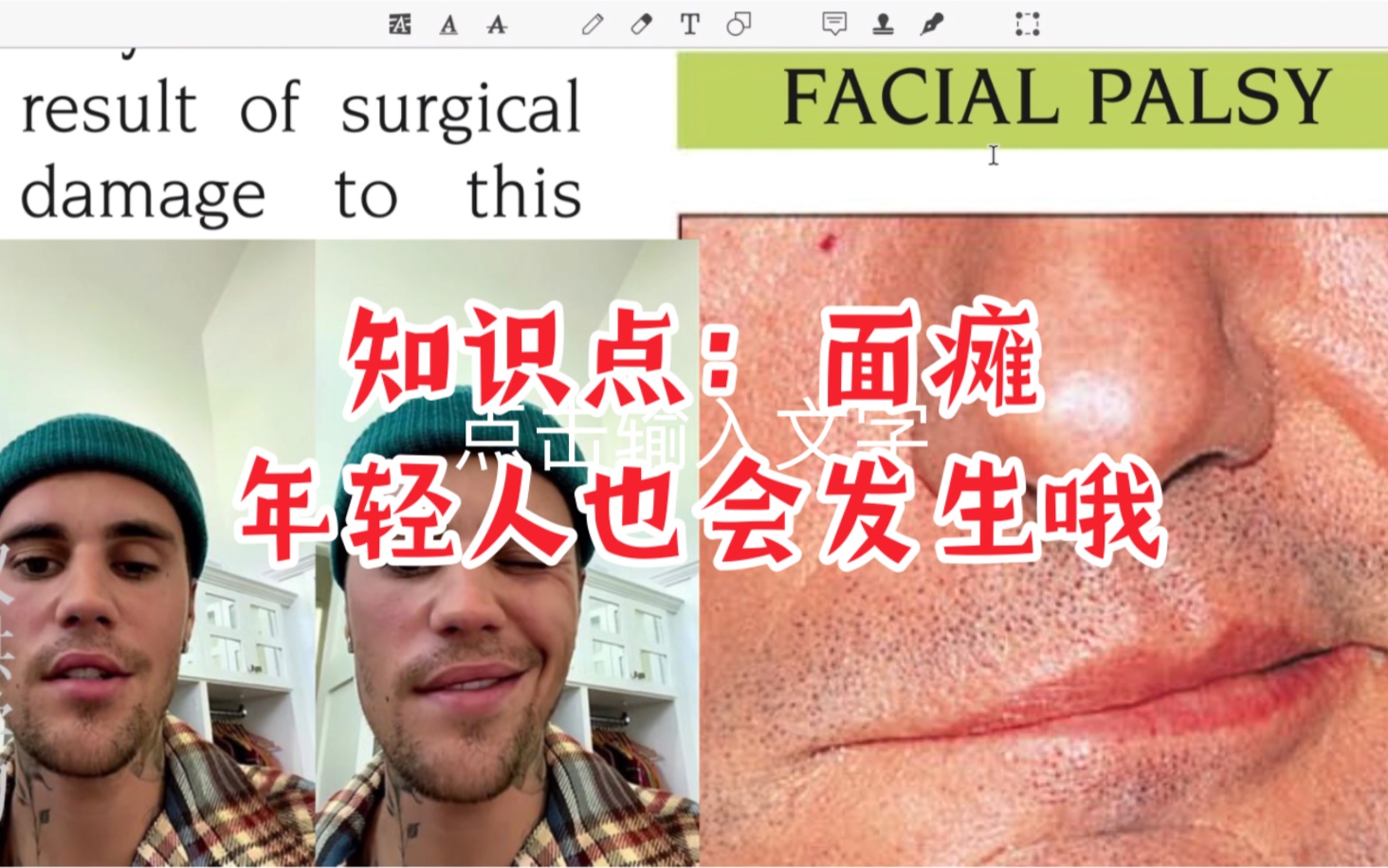 【医学英语】面瘫:Facial palsy. 是的,年轻人也会发生哦,比如Justin Bieber.哔哩哔哩bilibili