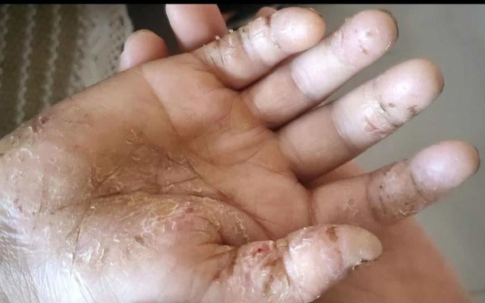 满手裂口脱皮一抹就好?揭秘内部人士分享的3个妙招,建议收藏!