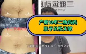 Download Video: 生完肚皮皱巴巴!!皮肉分离!!终于有救了