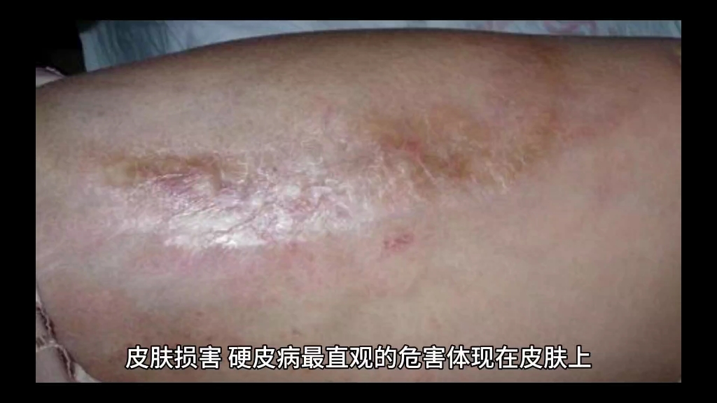 硬皮病的危害:深入了解这一复杂疾病