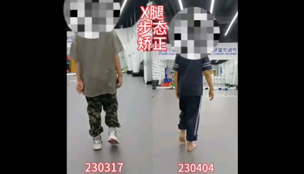 x腿型步态调整