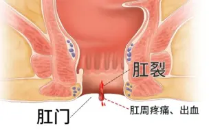 【医学喵】如何治疗肛裂？