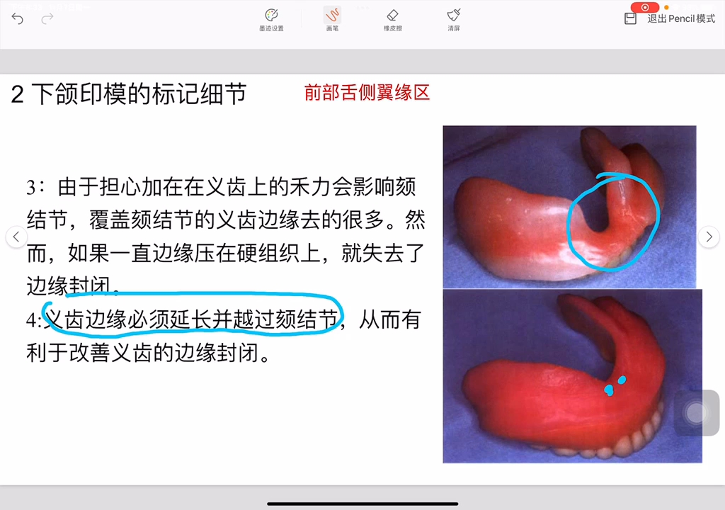 颊系带图片