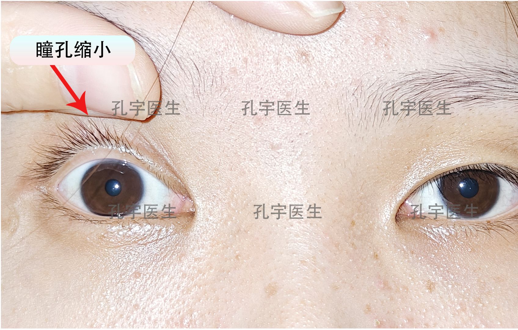 用缩瞳缩不正常大小