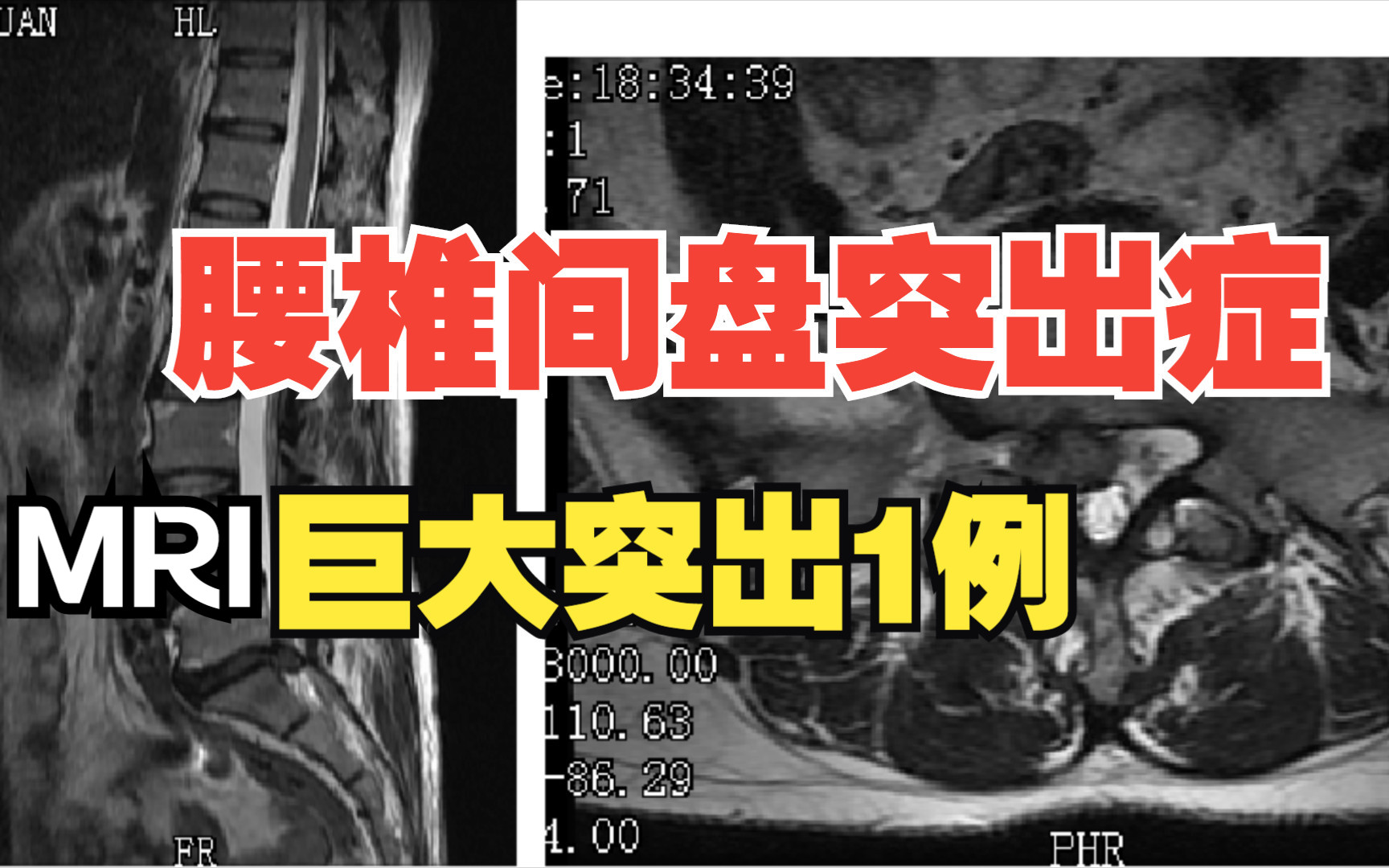 直击现场:腰椎间盘突出MRI影像解析1例哔哩哔哩bilibili