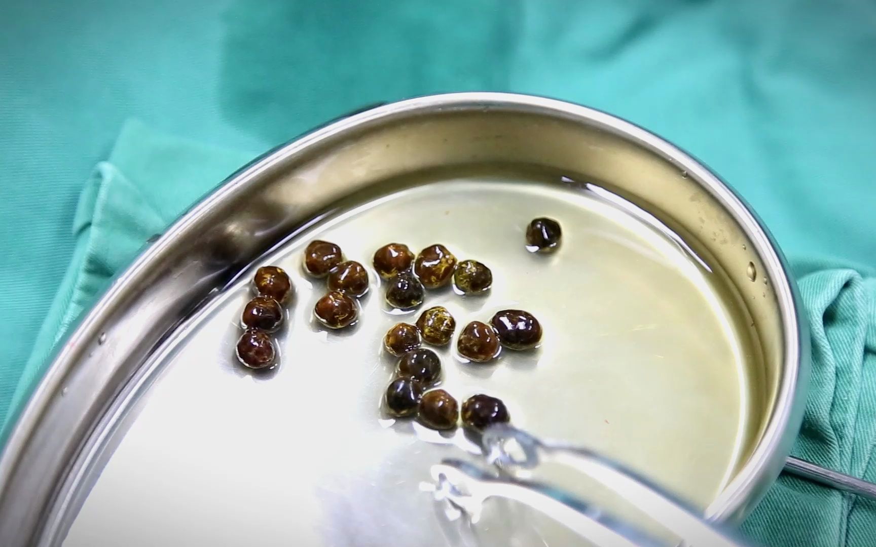 四川一女子腹痛就医,肝胆外科陈红春主任腹腔镜手术取出19颗胆结石