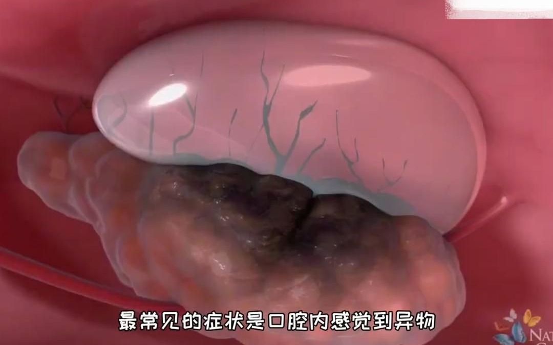 造成舌下腺囊肿