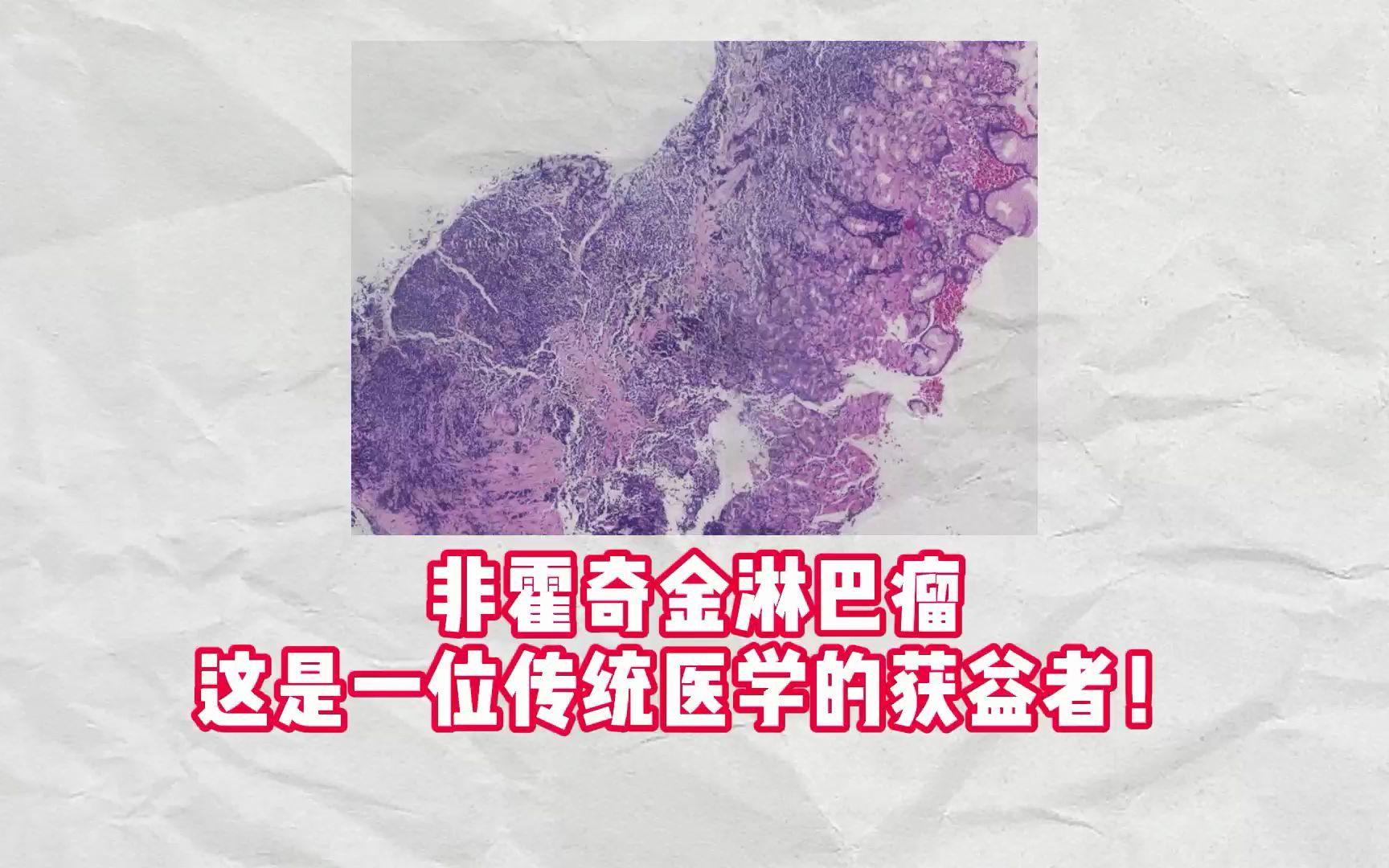 非霍奇金淋巴瘤患者病情稳定这是一位传统医学的获益者