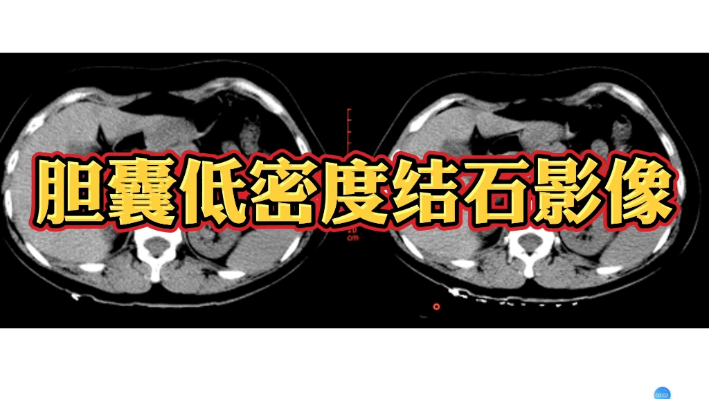 特殊类型胆囊结石CT及MRI表现!注意别漏诊!哔哩哔哩bilibili