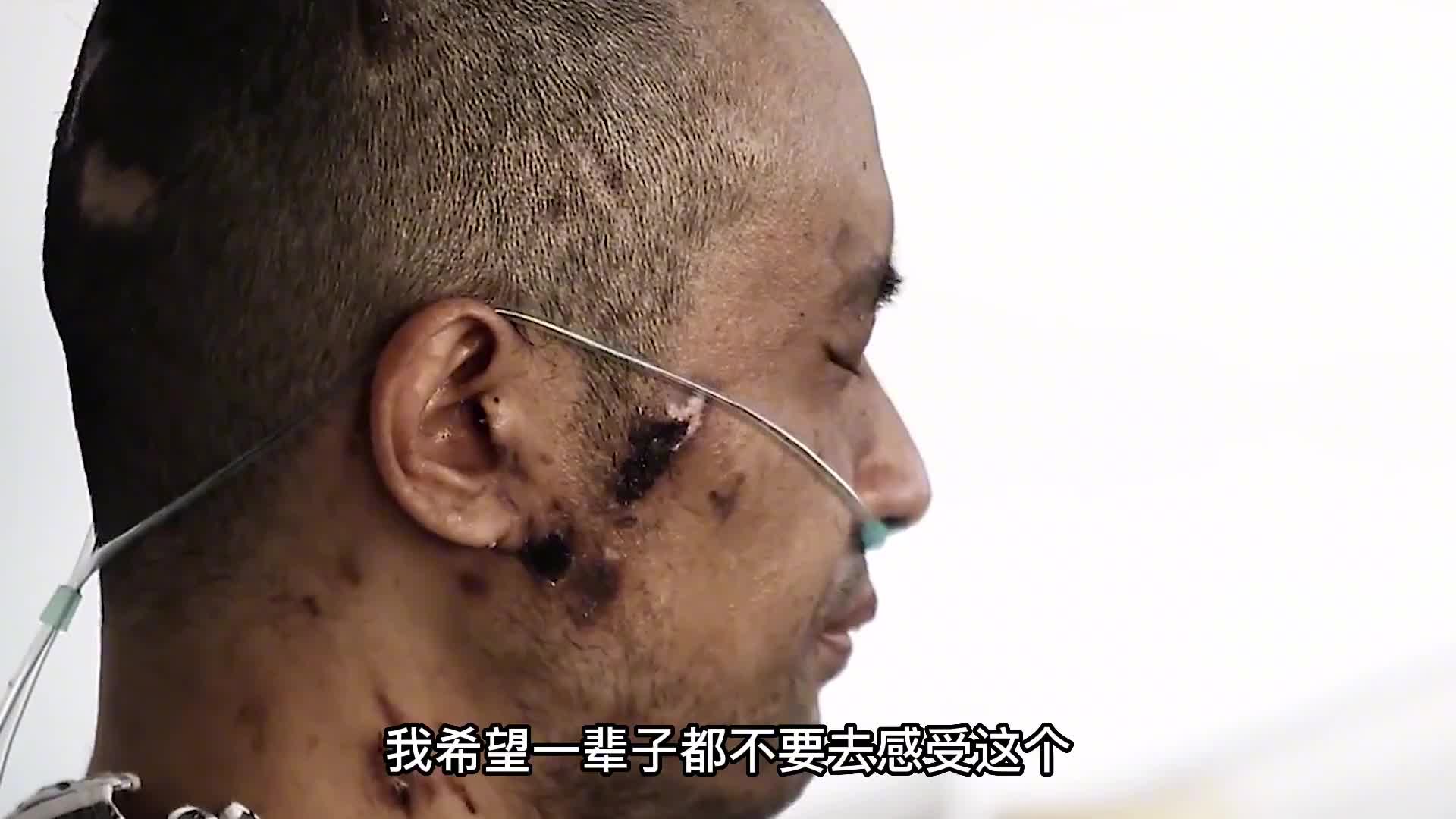 感染疫情会有后遗症吗(得了疫情后遗症)