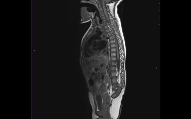 118 (尾部退化综合征,妊娠糖尿病所致)Caudal Regression Syndrome, secondary to maternal diabetes哔哩哔哩bilibili