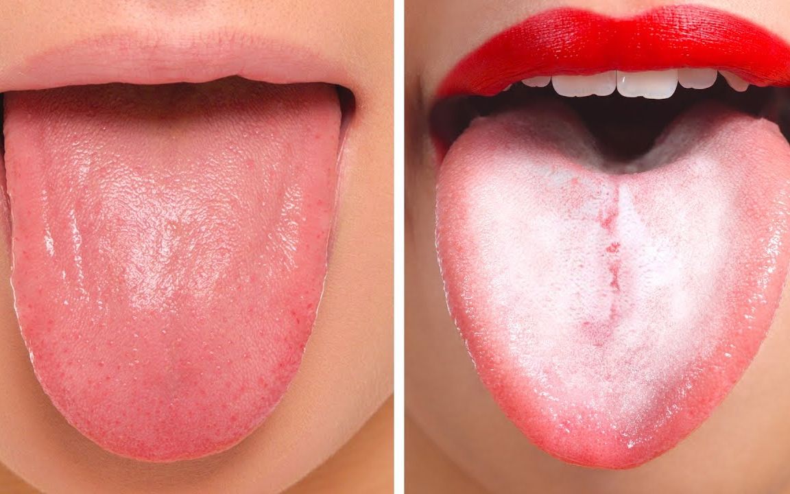 18个舌苔颜色告诉你身体健康状况!(马上拿出镜子照照还好死不了)