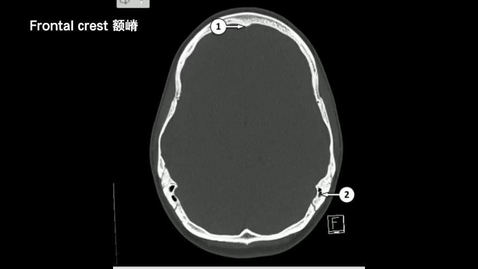 头颅CT骨窗解剖哔哩哔哩bilibili