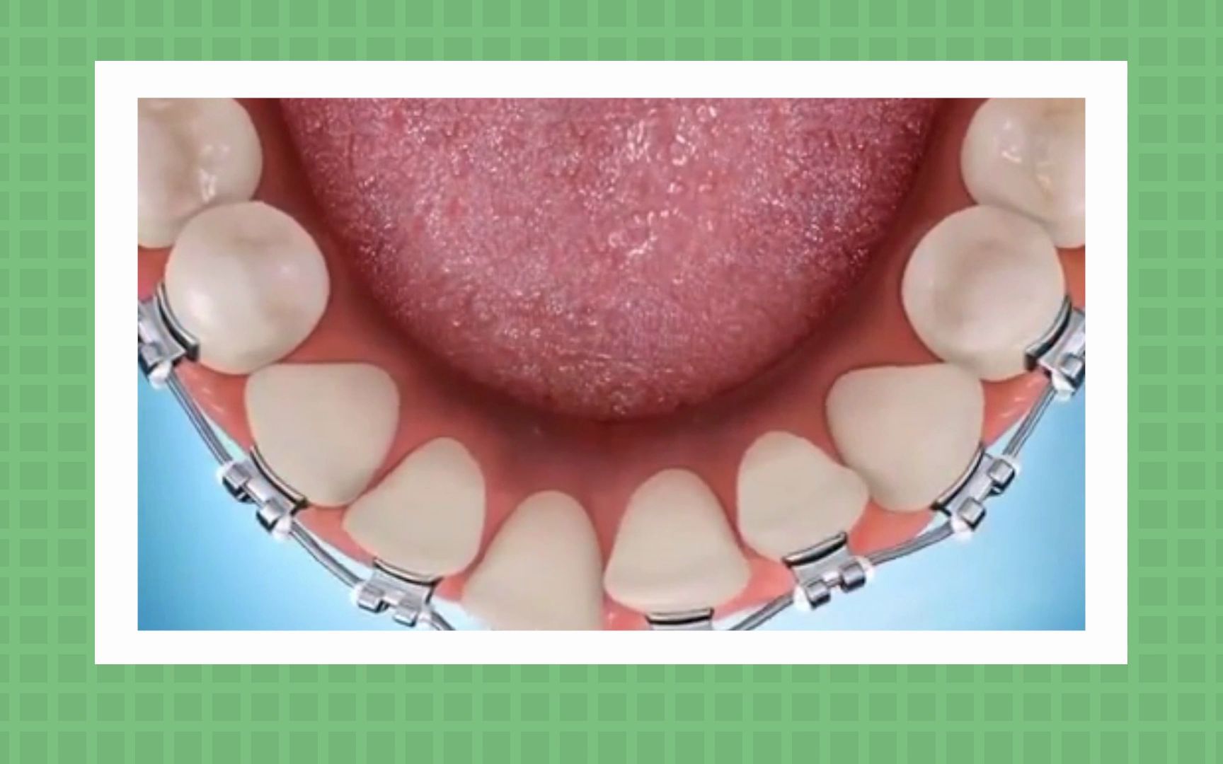 牙齿正畸:片切疼不疼