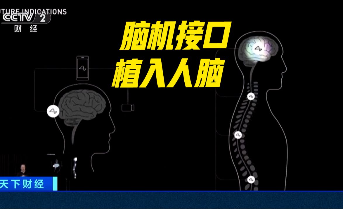 马斯克旗下公司完成首例脑机接口设备人体移植实验哔哩哔哩bilibili