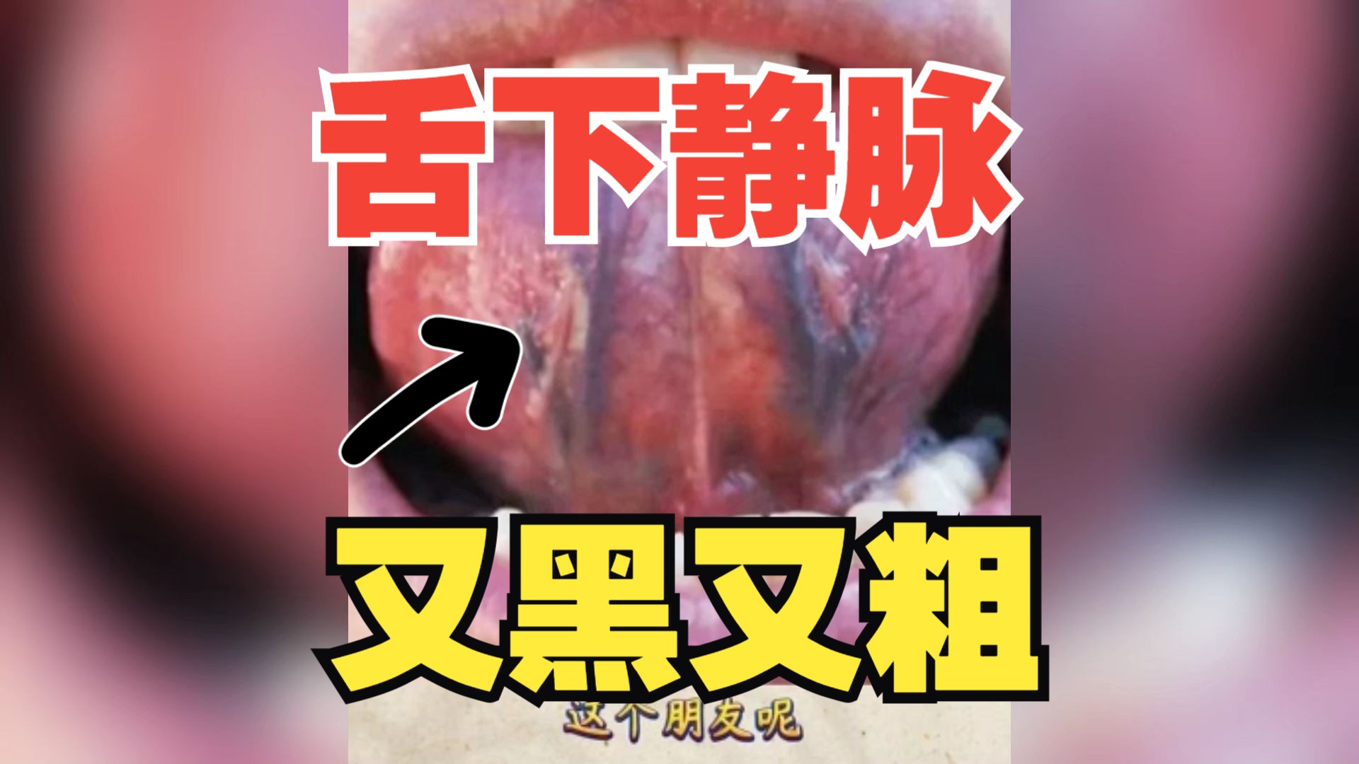 舌下静脉又黑又粗 到底是什么原因