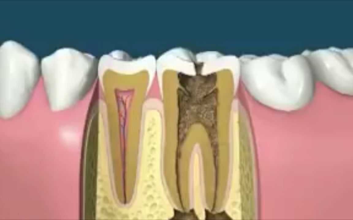 陈代新医生科普,牙齿龋坏到牙髓根管治疗怎么做的?哔哩哔哩bilibili