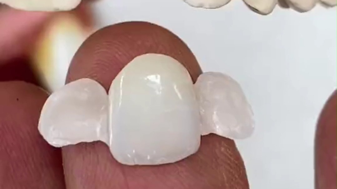 马里兰桥修复缺失牙,不磨牙粘接!