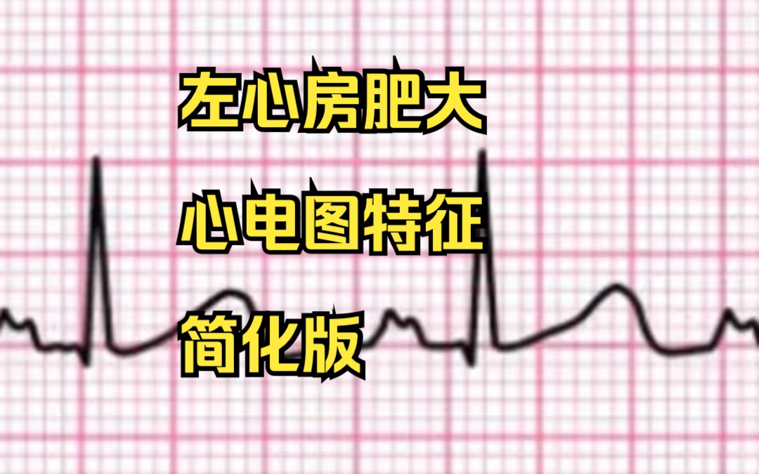 左心房肥大 ECG心点图特征 简化版哔哩哔哩bilibili