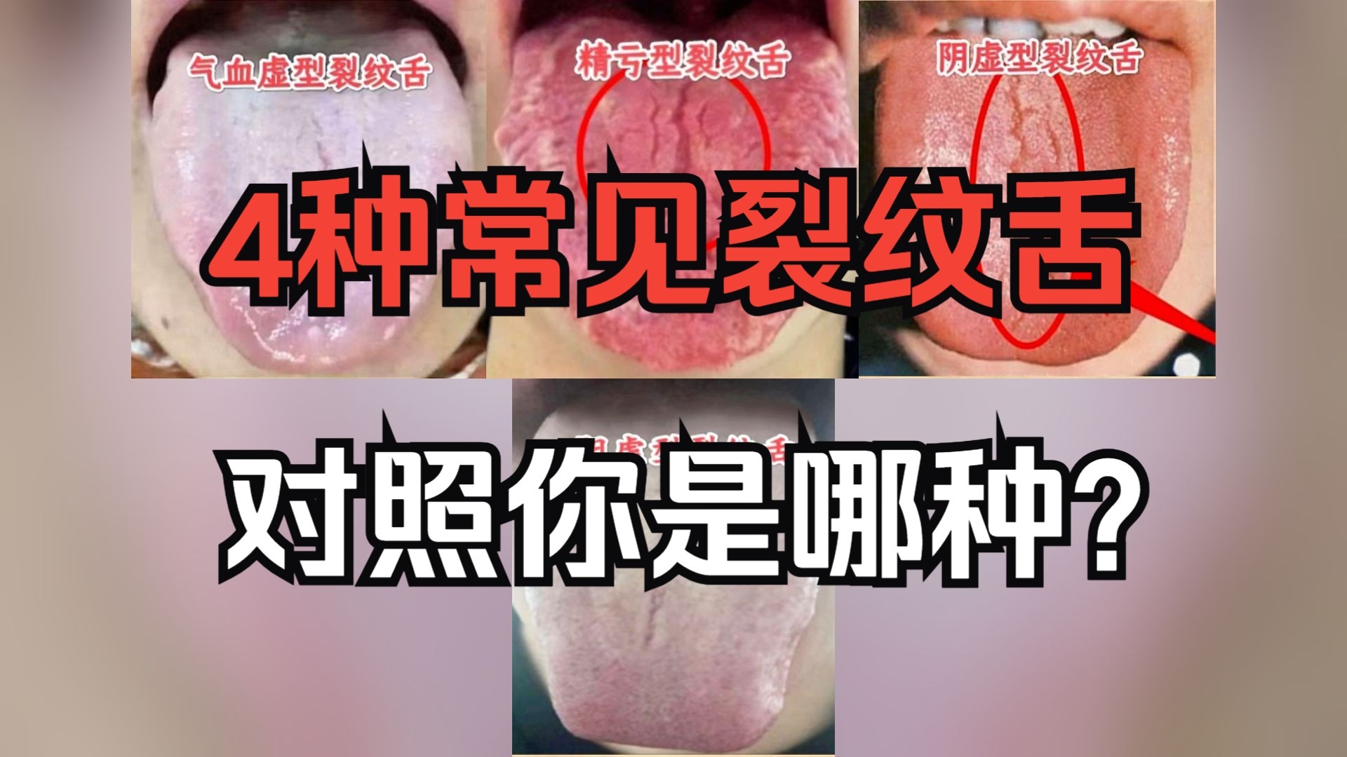舌头裂纹越长,人的寿命越短!4种常见舌裂舌,一次讲清楚!