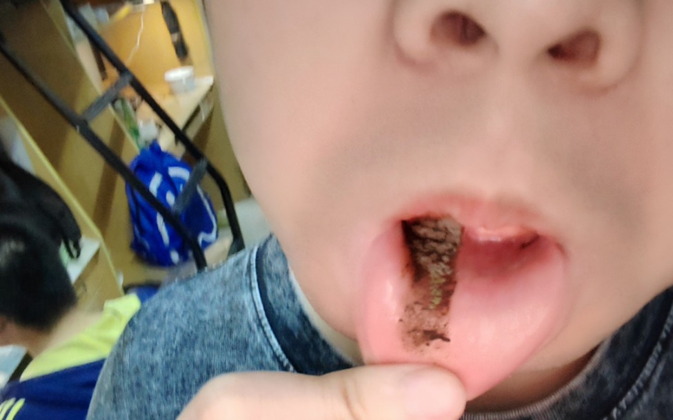 当你口腔溃疡西瓜霜喷多了