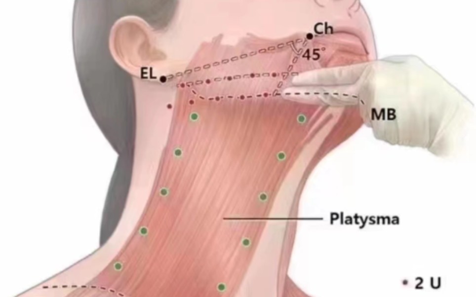 天鹅颈打造8915为什么下颌缘提升一定要打 颈阔肌牵拉的力是向下