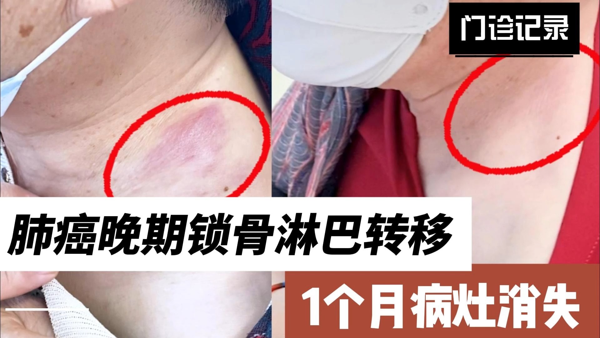 肺癌晚期,锁骨淋巴转移,1个月病灶消失