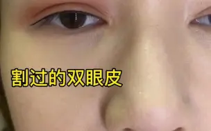 Скачать видео: 割过的双眼皮肿眼泡双眼皮怎么变成妈生眼呢