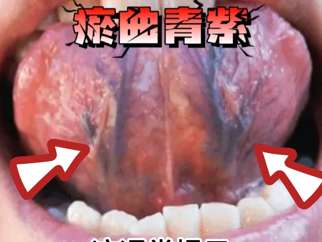 舌象分析:舌下静脉又黑又粗,到底是什么原因?