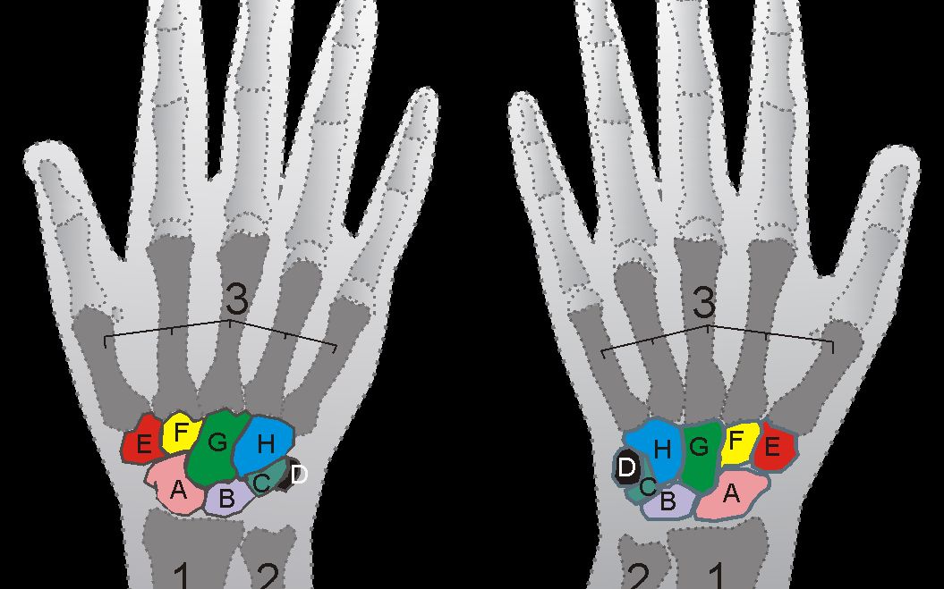 手腕骨关节炎/Arthrose in der Handwurzel哔哩哔哩bilibili