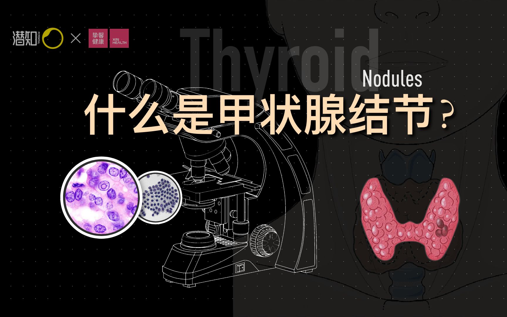 三分钟搞清楚,什么是甲状腺结节?哔哩哔哩bilibili