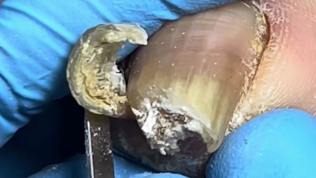 可怕的卷曲灰指甲!超长指甲!