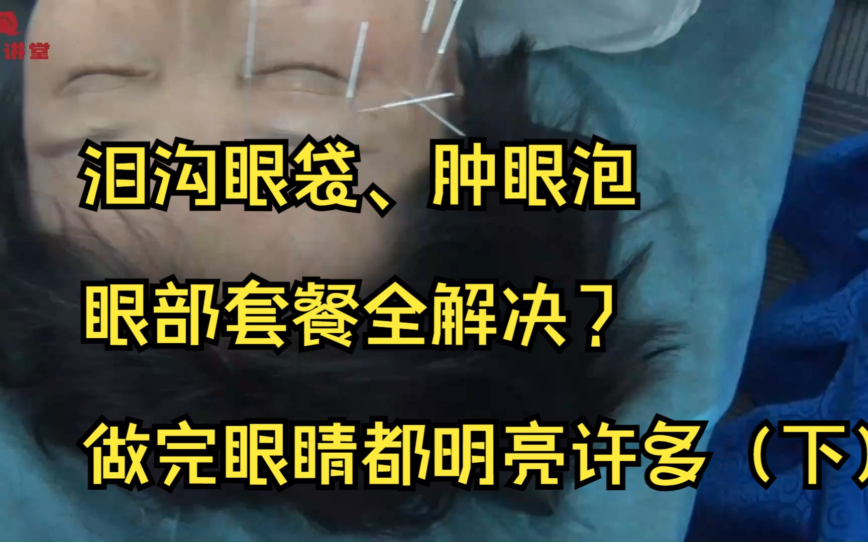 泪沟眼袋、肿眼泡,眼部套餐全解决?做完眼睛都明亮许多(下)哔哩哔哩bilibili