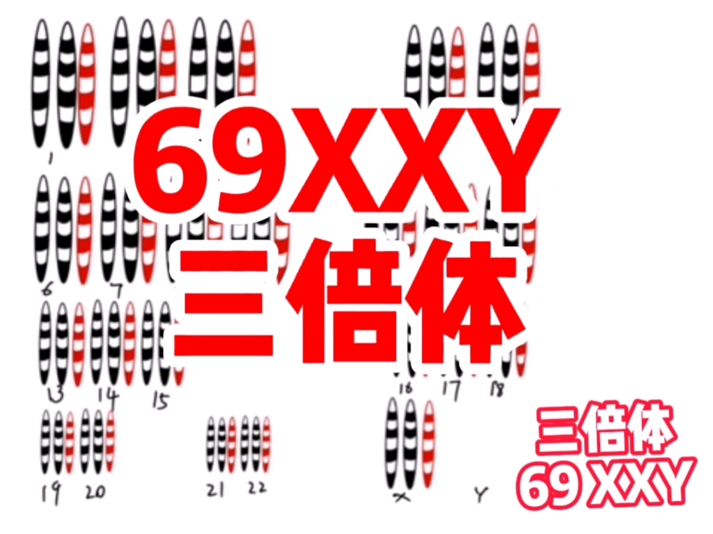 69XXY染色体异常哔哩哔哩bilibili