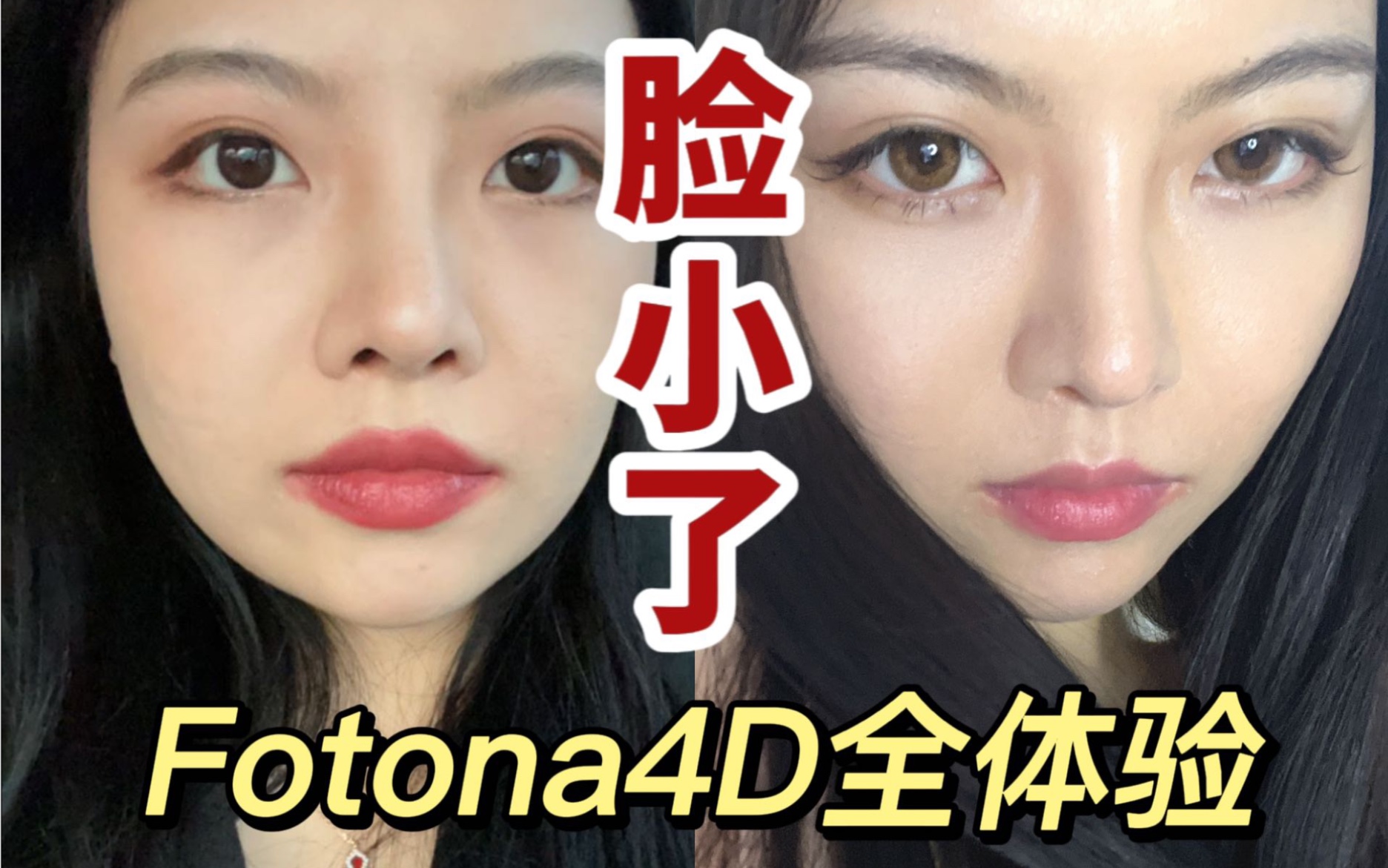 肉脸马上就小了!fotona4D真香|全过程体验记录及恢复期分享哔哩哔哩bilibili