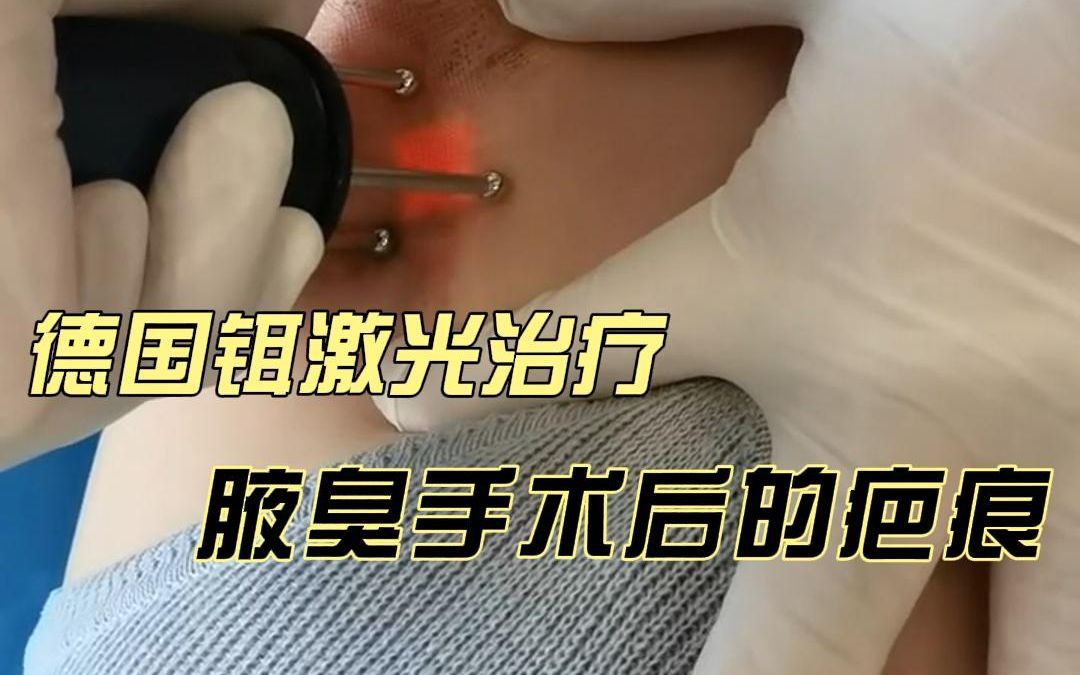 德国铒激光治疗腋臭手术后的疤痕