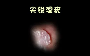 Descargar video: 治疗尖锐湿疣该怎么选择？