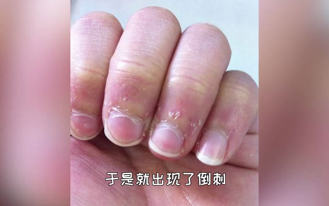 为什么手上会长倒刺?手长了倒刺后如何正确处理?