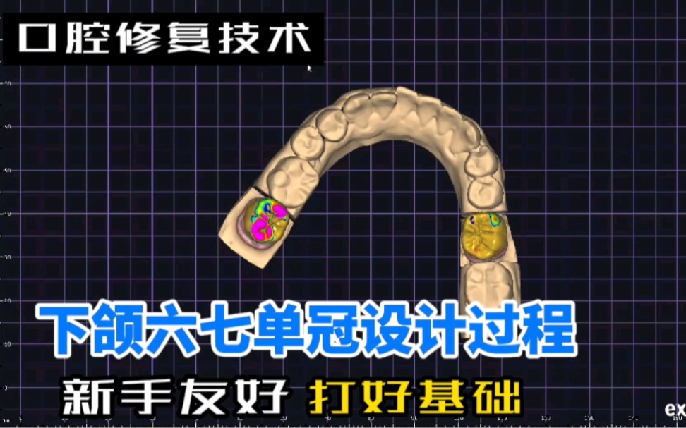 [口腔修复技术]新手向下颌单冠六七的制作过程打好基础哔哩哔哩bilibili