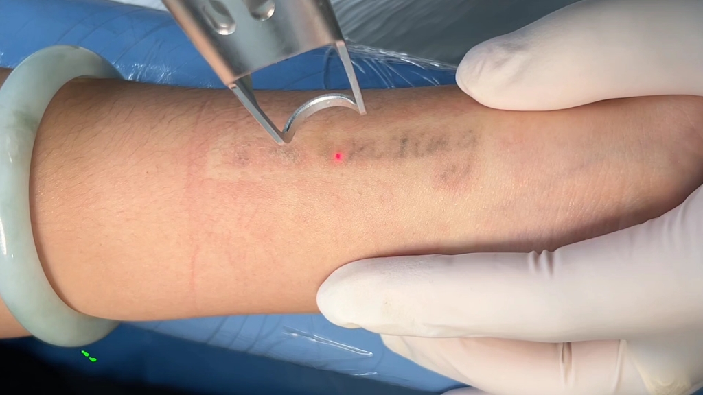 英文字母第二次无痛清洗,记录洗纹身全过程